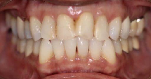 Teeth 1 Before Maple Avenue Family Dentistry