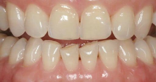 Teeth 3 Before Maple Avenue Family Dentistry
