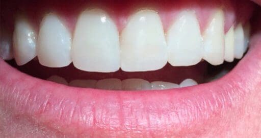 Teeth 5 After Maple Avenue Family Dentistry