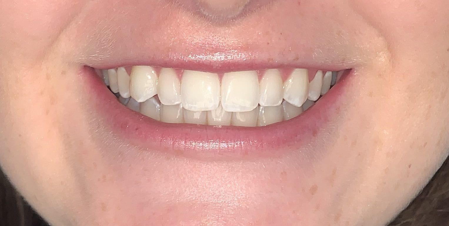 Sidney 1 tray IMG 6287 Maple Avenue Family Dentistry